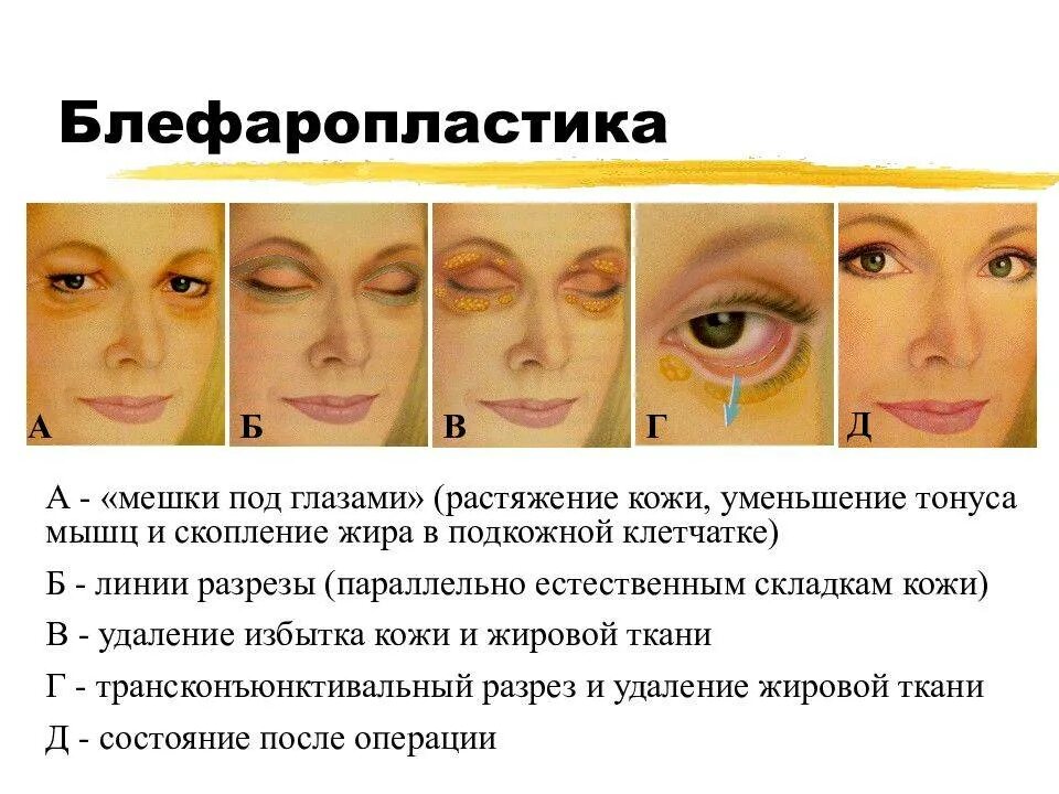Отекло лицо утром как убрать. Мешки под глазами. Отечные мешки под глазами. Типы отеков под глазами.