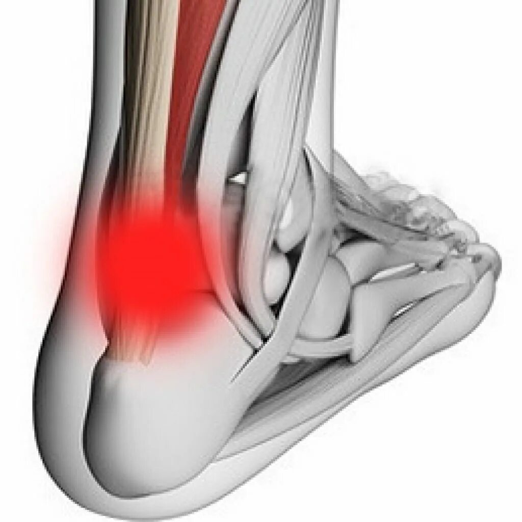 Пяточная шпора ахиллова сухожилия. Фасциит голеностопного сустава. Пяточное ахиллово сухожилие. Пяточная шпора ахиллова шпора. Почему болят сухожилия пятки