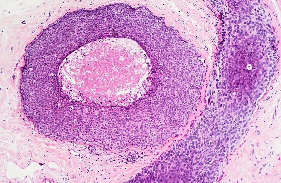 Плоскоклеточный Канцер. Плоскоклеточная карцинома in situ гистология. Гистология плоскоклеточный Канцер ин ситу. Рак in situ шейки