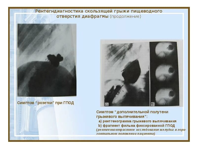 Как лечить диафрагму грыжу