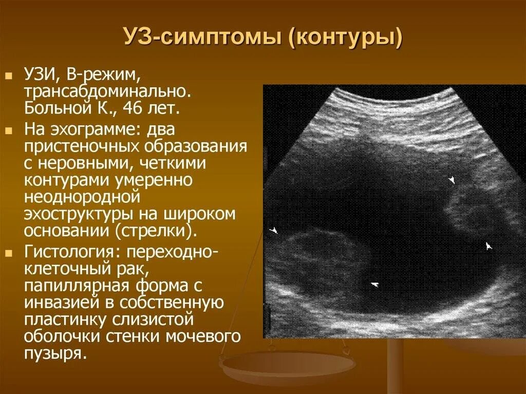 Что образуется в яичниках. Опухоль карцинома мочевого пузыря. Ультразвуковое исследование (УЗИ) мочевого пузыря. Киста яичника УЗИ трансабдоминальное. Объемное образование мочевого пузыря на УЗИ.