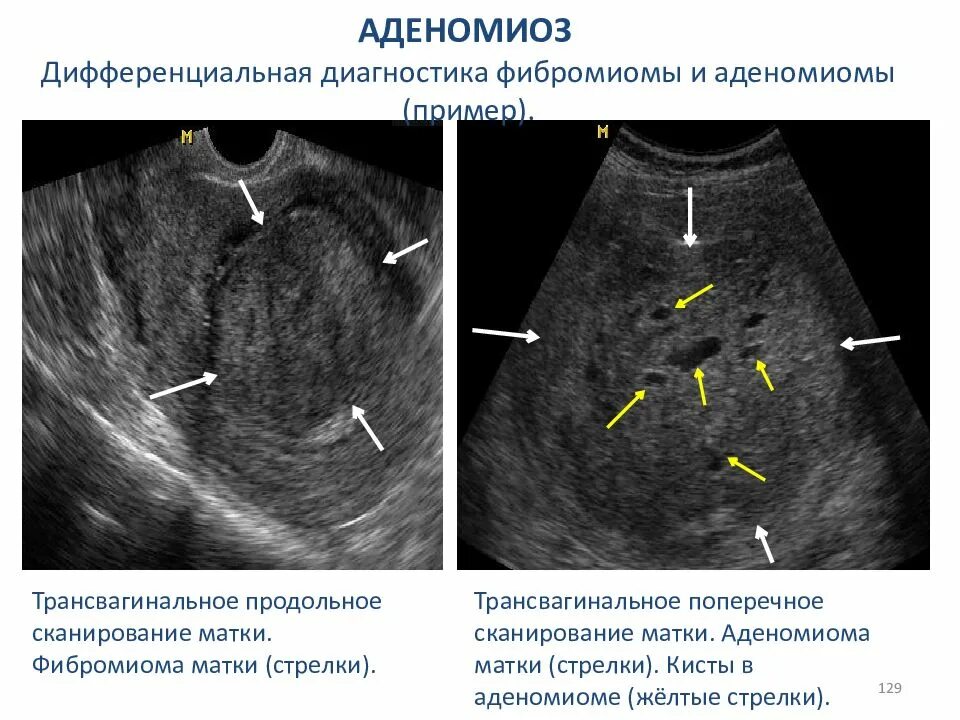 Эхо аденомиоза