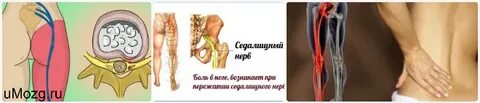 Какие лекарства принимать при седалищном нерве