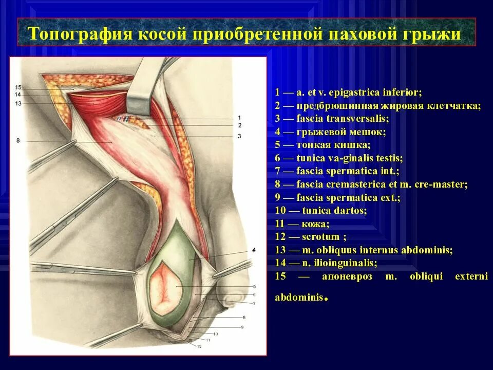 Косая и прямая паховая грыжа. Двухсторонняя косая паховая грыжа. Цена лечения паховых грыж