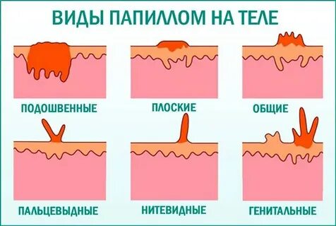 Вирус папилломы гинекология как передается