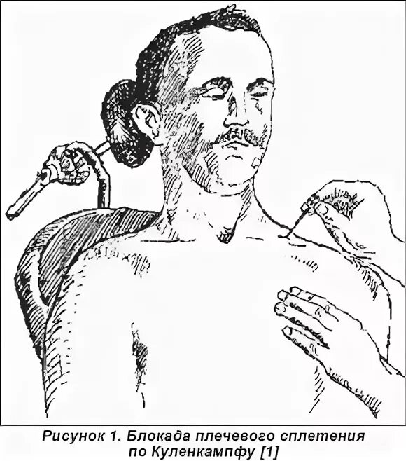 проводниковая анестезия плечевого сплетения по куленкампфу. блокада шейного сплетения по куленкампфу. проводниковая анестезия по куленкампфу. анестезия плечевого сплетения по куленкампфу. куленкампфа проводниковая анестезия.