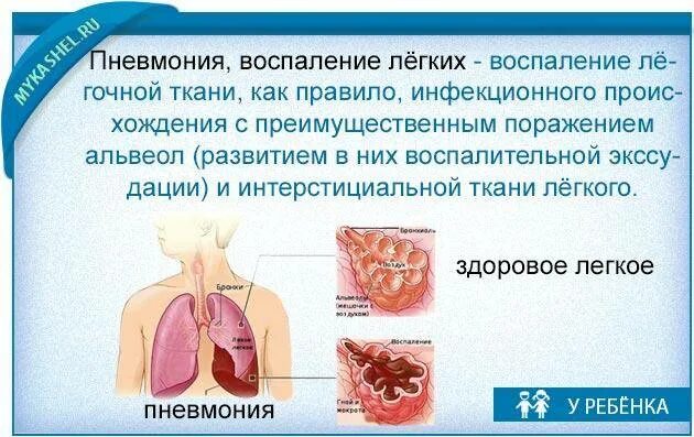 Очень сильно кашляю. Сильный кашель с мокротой. Кашель с мокротой без температуры у взрослого. Кашель не откашливается у ребенка.