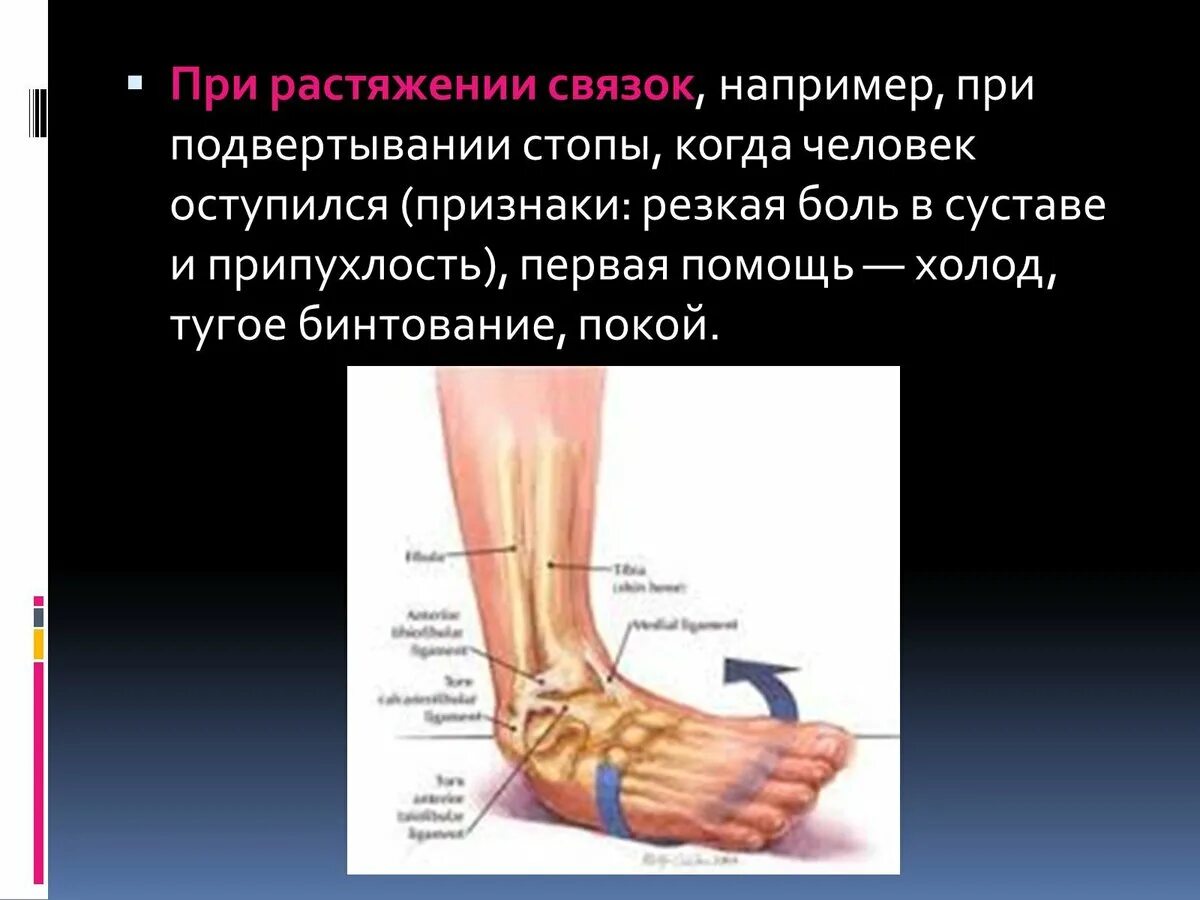 Первая при растяжении связок. Растяжение связок стопы. При растяжении связок стопы. Презентация на тему растяжение.