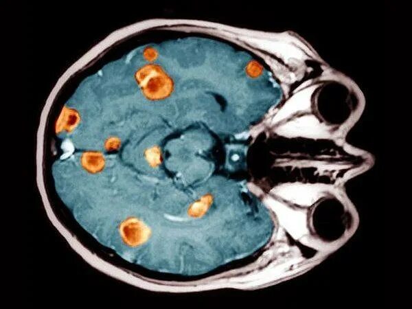 Меланома метастазы в мозг. Метастазы в головном мозге. Метастазы меланомы в головной мозг. Метастатические опухоли головного мозга.