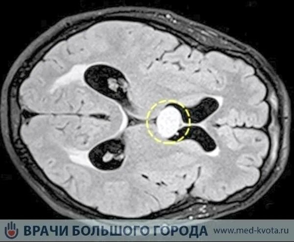 Диффузная глиома ствола головного мозга. Глиома зрительного нерва. Диффузная срединная глиома мутантная н3к27-.