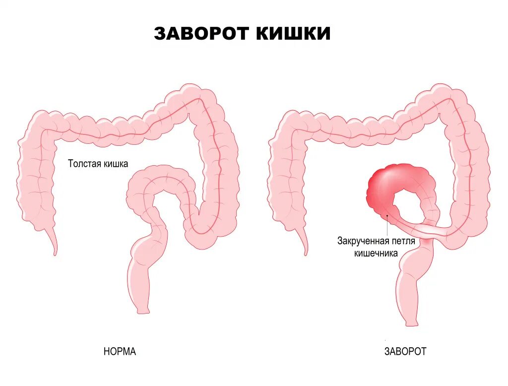 От чего может быть заворот. Заворот сигмовидной кишки.