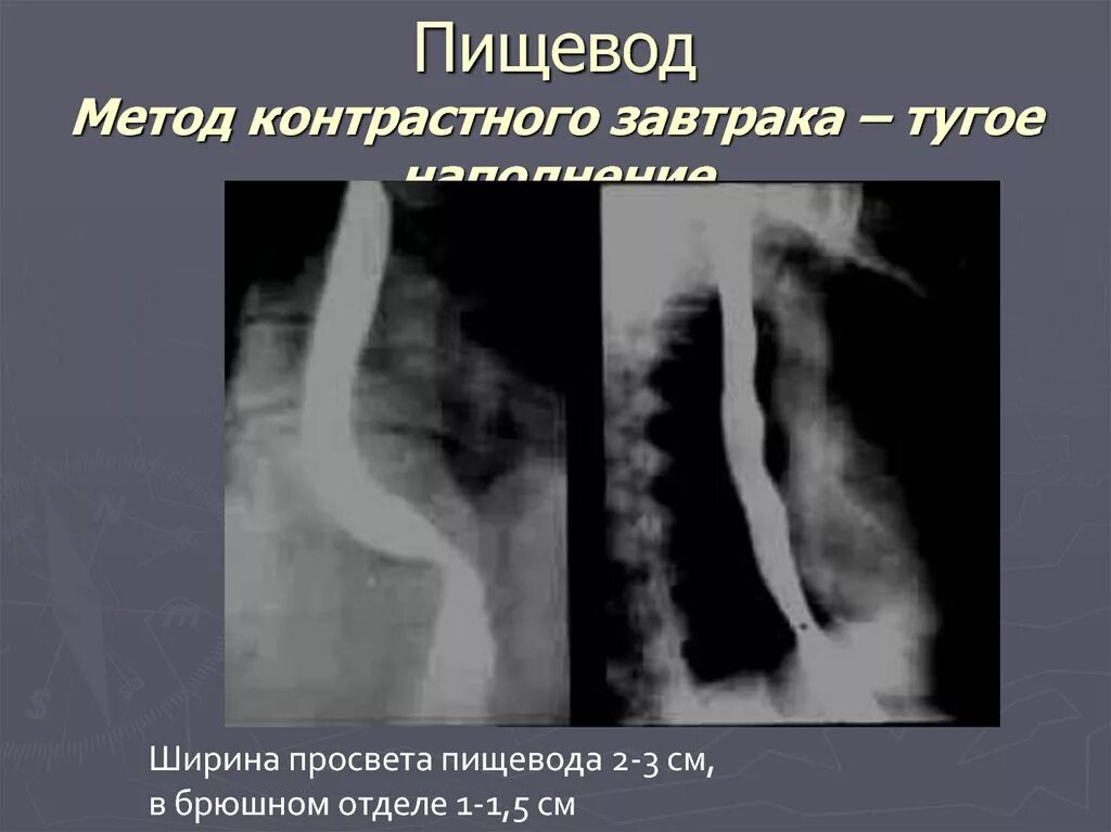 Пищевод проходит. Рентгеноанатомия пищевода. Ширина пищевода.