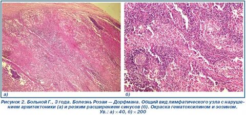 Болезнь розаи дорфмана что