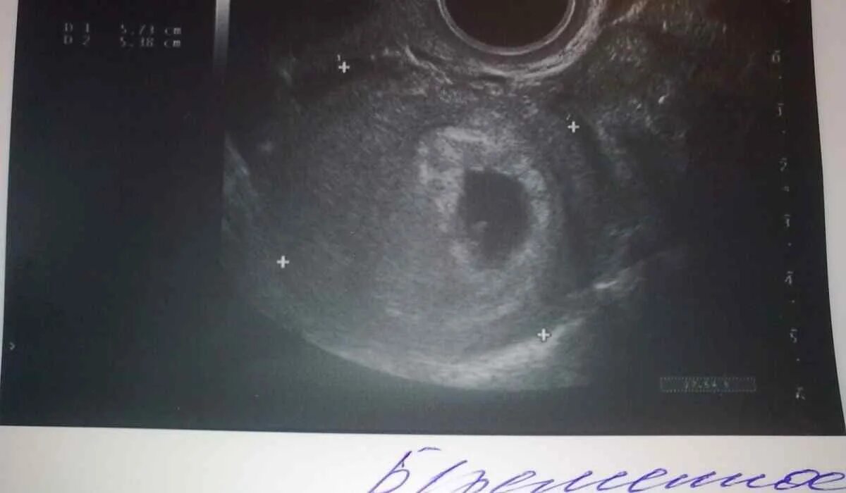 Плодное яйцо 3 мм. УЗИ 4-5 недель беременности. УЗИ 5 недель беременности УЗИ. УЗИ беременности 2.5 недели. Снимок УЗИ беременности 4-5.