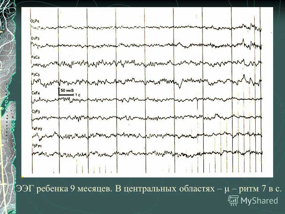 Ээг ребенку 3 года. ЭЭГ. Гамма ритм ЭЭГ. Fp1-f3 ЭЭГ. Лямбда волны на ЭЭГ.