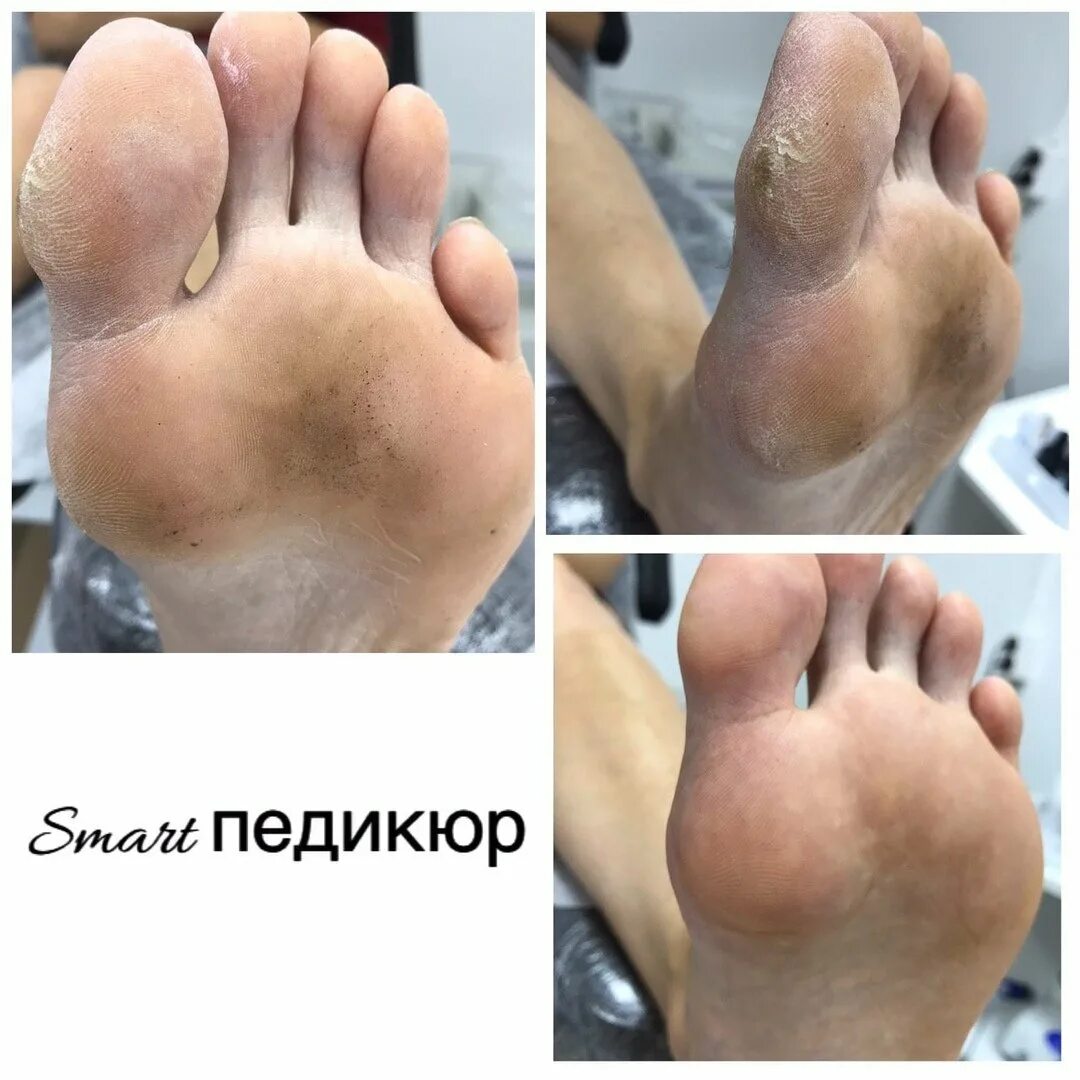 педикюр аппаратный smart. смарт педикюр до и после. чем отличается смарт педикюр от обычного. смарт педикюр до и после. чем отличается смарт педикюр от обычного.