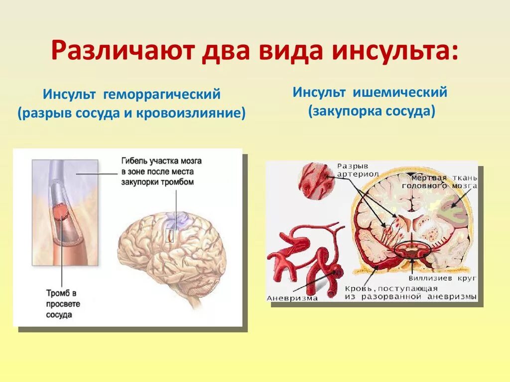 Инсульт 2 степени. Два типа инсульта. Две разновидности инсульта. Различают инсульт.