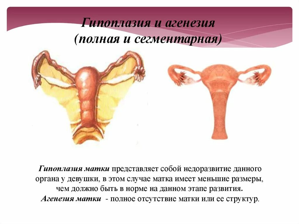 Матка 37 мм. Гипоплазия наружных половых органов. Гипоплазия матки. Гипоплазия матки и влагалища.