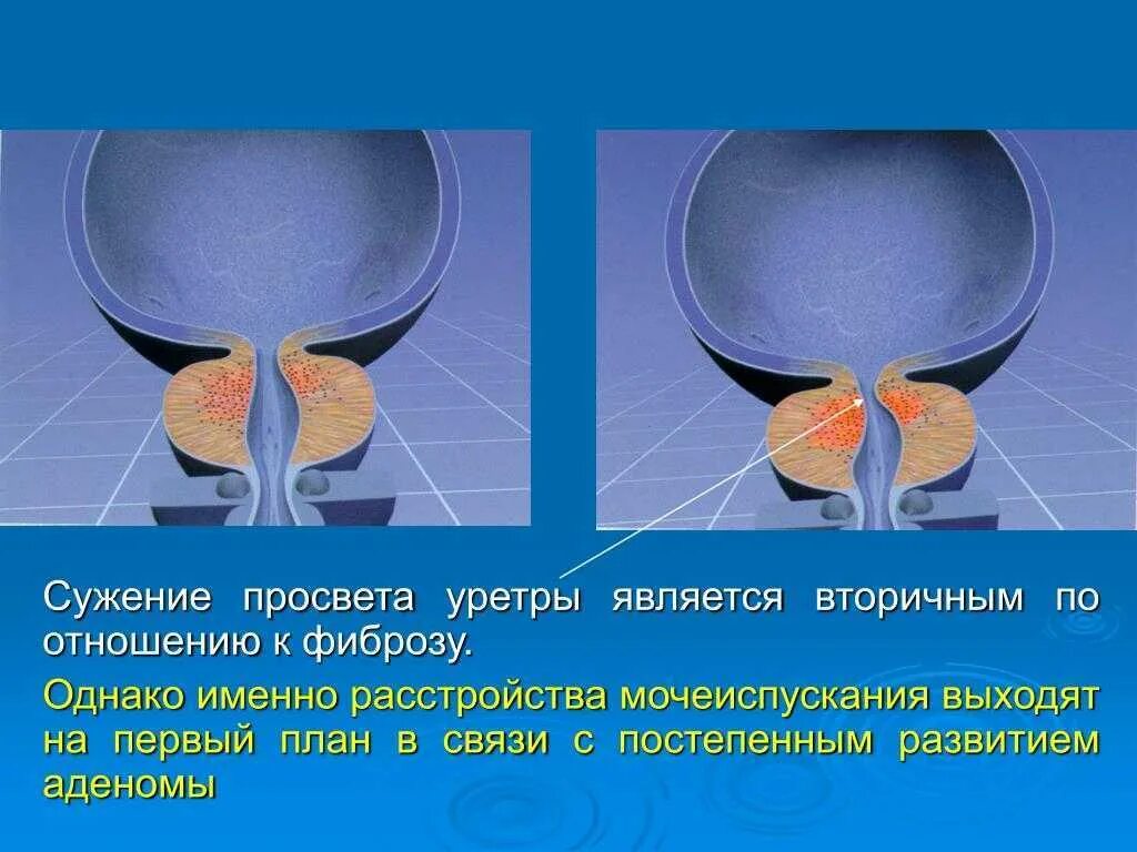 Сужение мочеиспускательного канала. Сужения мужского мочеиспускательного. Сужения мужского мочеиспускательного канала.