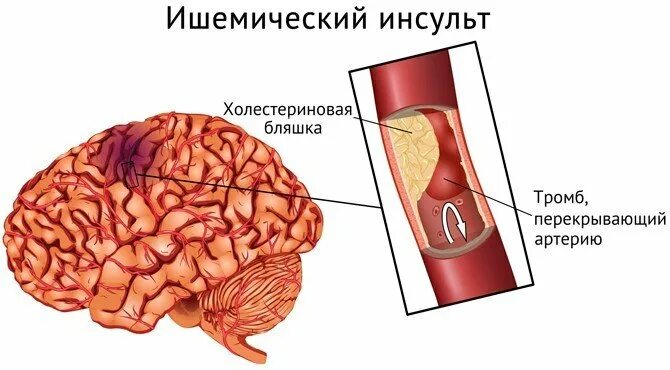 Заболевания ишемического инсульта. Ишемический инсульт головного мозга. Острый ишемический инсульт. Очаг ишемического инсульта.