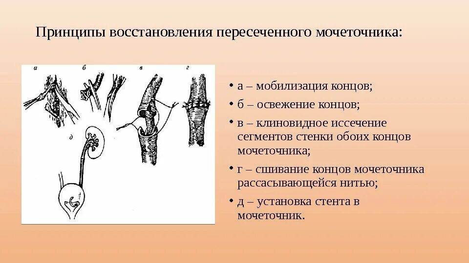 Развитие мочеточников. Принципы регенерации. Мобилизация мочеточников это. Повреждение мочеточника при гинекологических операциях. Источник развития мочеточника.