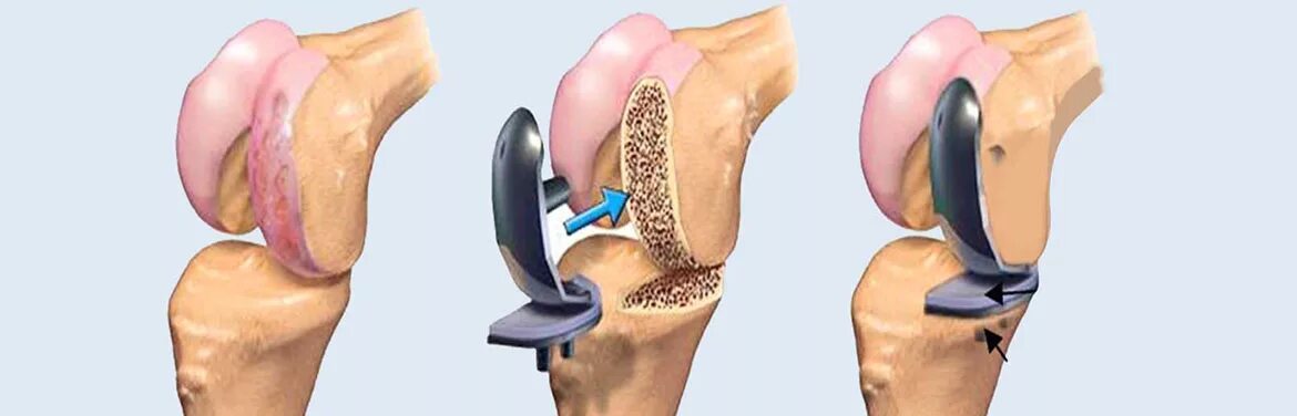 эндопротезирование коленного сустава. эндопротез тазобедренного сустава операция. протез коленного сустава. эндопротез локтевого сустава depuy. гемиартропластика тазобедренного сустава.