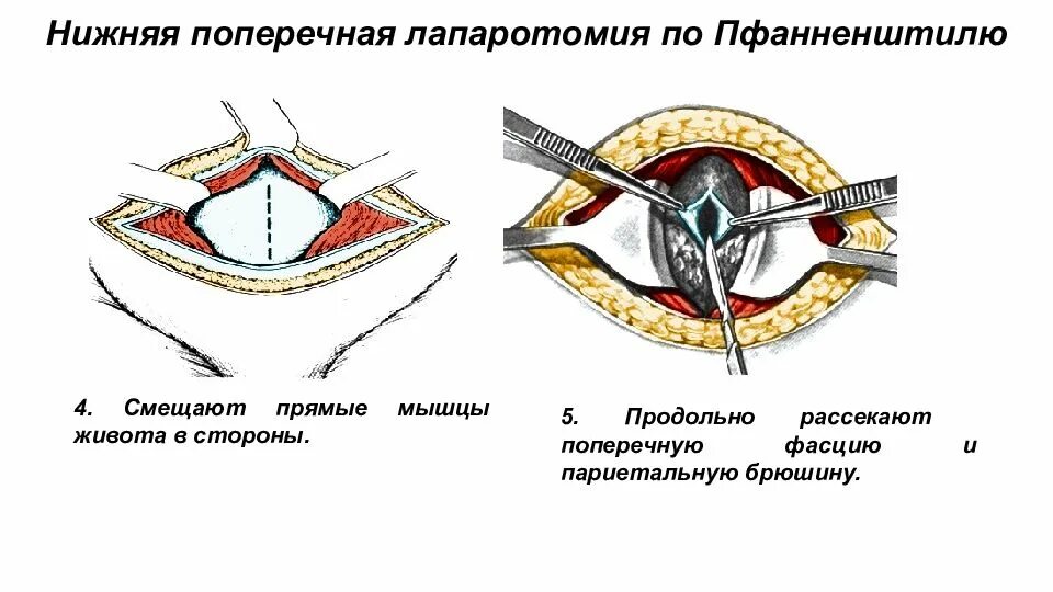 Какое лапаротомия. Надлобковый поперечный разрез по Пфанненштилю. Нижняя поперечная лапаротомия по Пфанненштилю. Поперечная надлобковая лапаротомия. Шов при лапаротомии по Пфанненштилю.