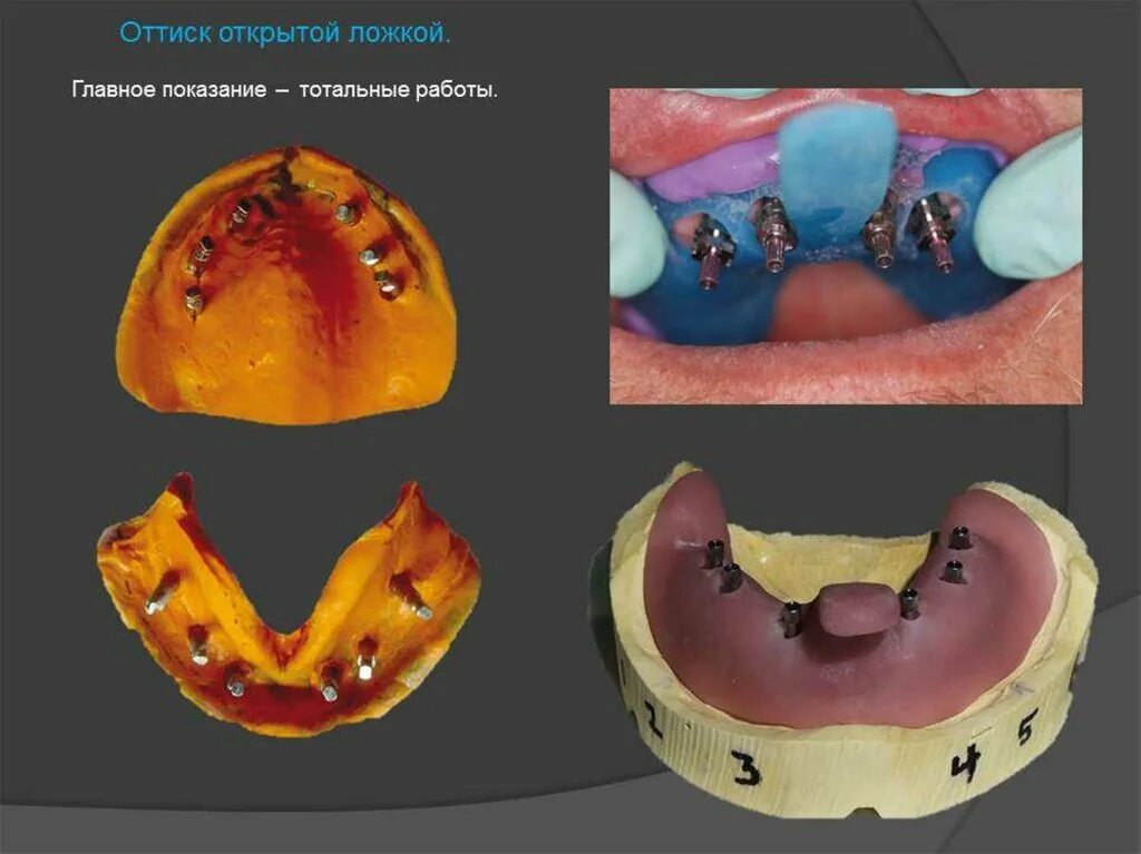 Индивидуальная ложка для имплантатов. Индивидуальная слепочная ложка для имплантов. Оттискные ложки для имплантатов. Индивидуальная оттискная ложка для имплантов. Тотальные работы