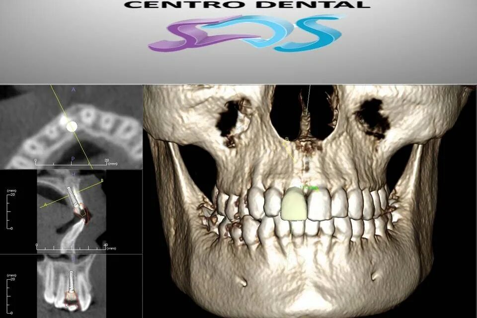 Можно ли с зубным имплантом делать мрт. Кт 3d верхней и нижней челюсти.