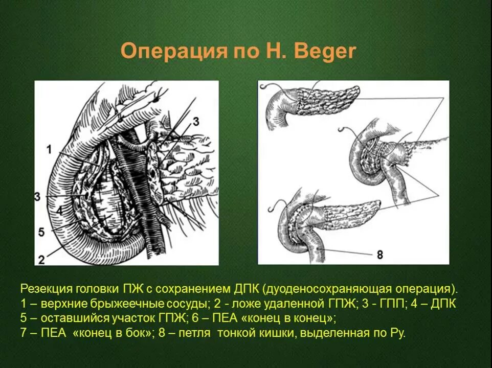 Резекция поджелудочной железы операция. Резекция головки поджелудочной железы. Субтотальная резекция поджелудочной железы. Операция Бегера на поджелудочной железе.