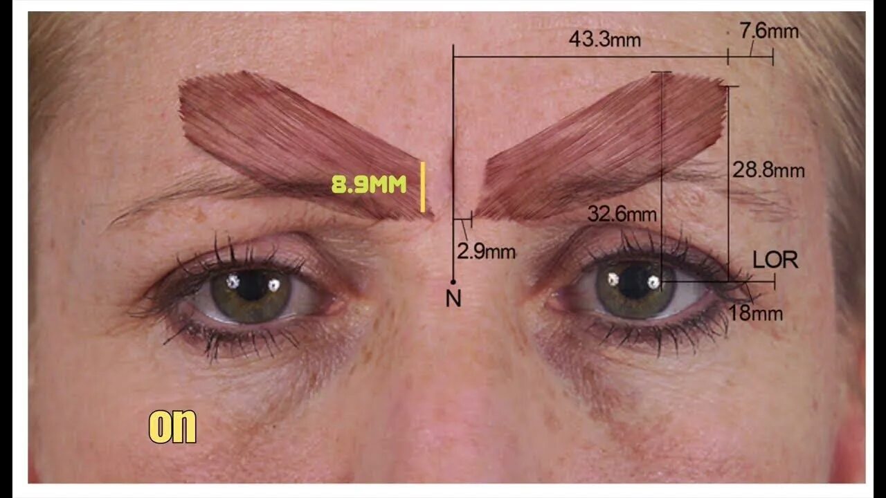 Колет бровь. Corrugator supercilii. Корругатор мышца. Мышцы над бровями. Корругатор анатомия.