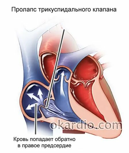 Марс в кардиологии. Марс пролапс митрального клапана. Пролапс трехстворчатого клапана. Пролапс клапана сердца трикуспидального. Пролапс немитрального клапана.