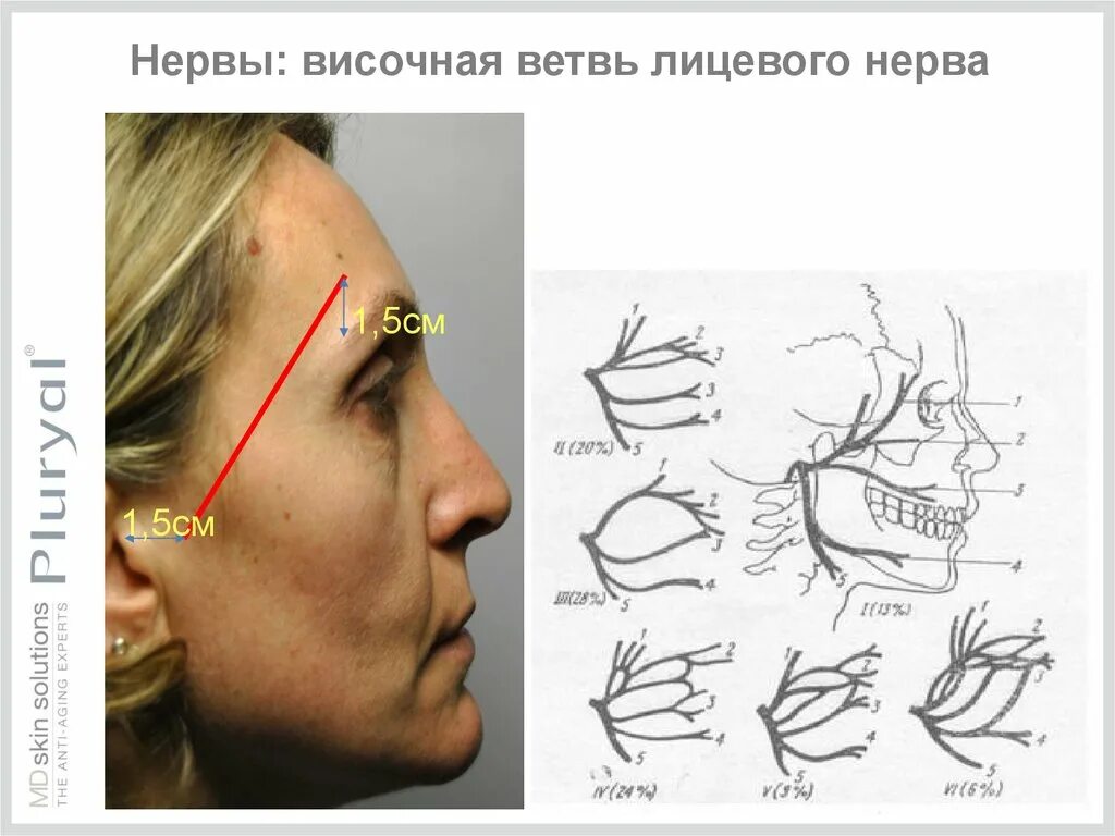 Тип лицевого нерва. Височная ветвь лицевого нерва. височный нерв лицевого нерва. височные нервы.