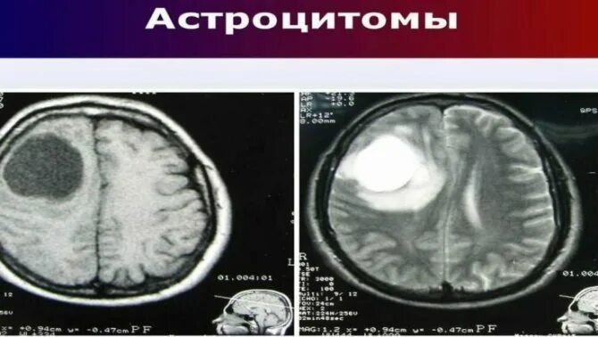 Пилоидная астроцитома. Пилоидная астроцитома мозжечка. Пилоцитарная астроцитома. Пилоидная астроцитома мрт. Астроцитома мозжечка мрт.