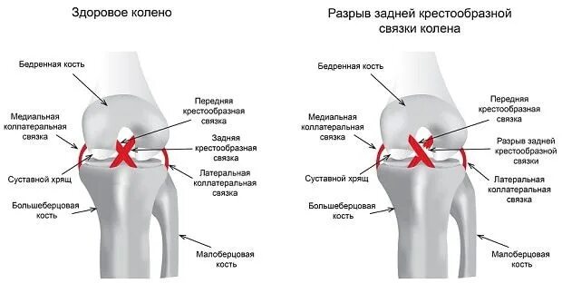 Крестовидная коленная связка. Разрыв передней крестовой связки коленного сустава. Разрыв передней и задней крестообразной связки коленного сустава. Симптомы повреждения задней крестообразной связки. Разрыв задних крестовых связок коленного сустава.
