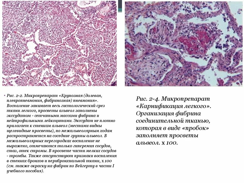Катаральная бронхопневмония гистология. Крупозная пневмония макропрепарат. Крупозная пневмония микропрепараты. Крупозная пневмония препарат патанатомия.