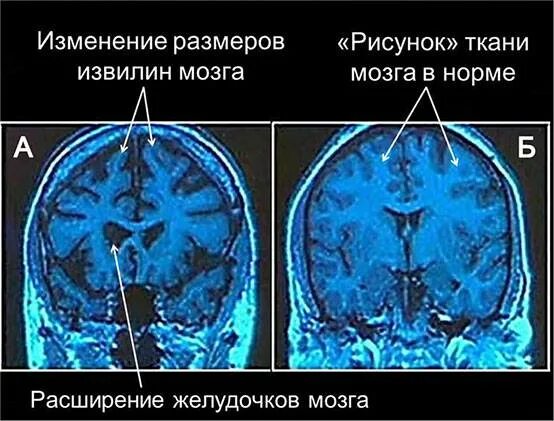 Боковые желудочки мозга у новорожденного