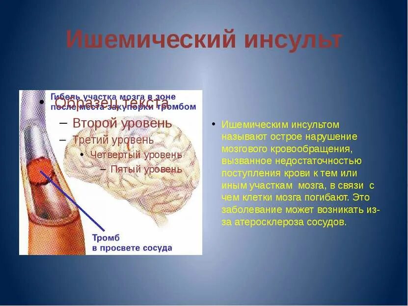 Профилактика инсульта. Ишемическая инсульт симптомы и лечение. Онмк геморрагический инсульт. Паралич правой стороны тела. Ишемический инсульт причины возникновения.