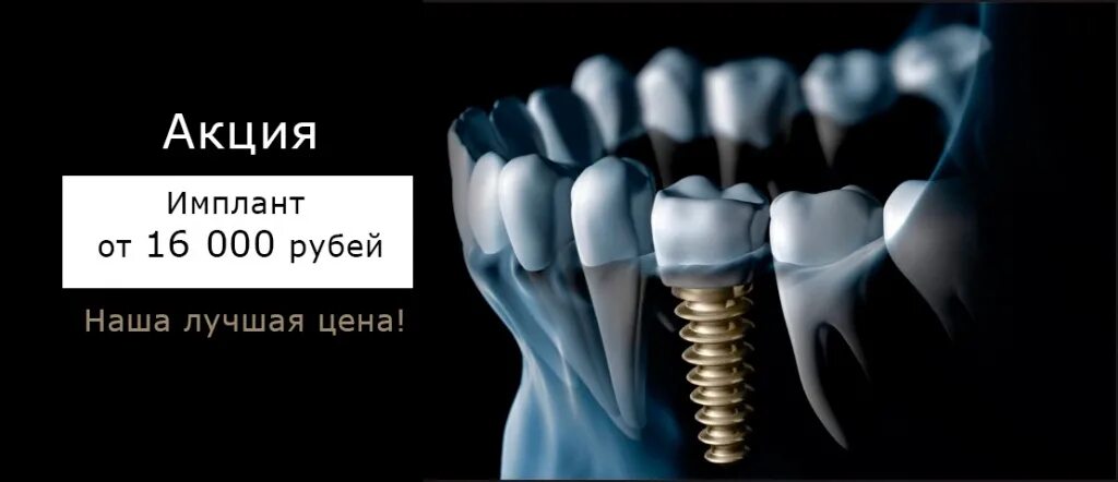 Имплант акция. Дентиум импланты. Имплант под ключ акция. Альфа био импланты. Реклама имплантации в стоматологии.