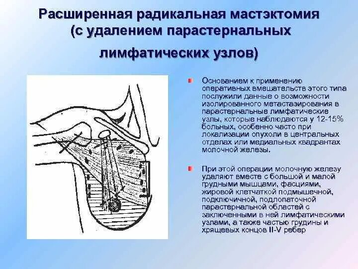 После операции молочной железы и лимфоузлов. Радикальная мастэктомия. Радикальная мастэктомия по Холстеду. Осложнения Радикальной мастэктомии. Протокол операции мастэктомии.