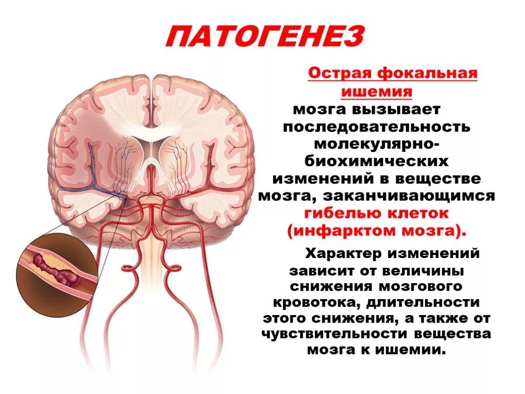 Инфаркт мозга причины. Патогенез ишемического инфаркта головного мозга. Патогенез развития ишемического инсульта. Хроническая ишемия мозга патогенез. Механизм развития инфаркта мозга.