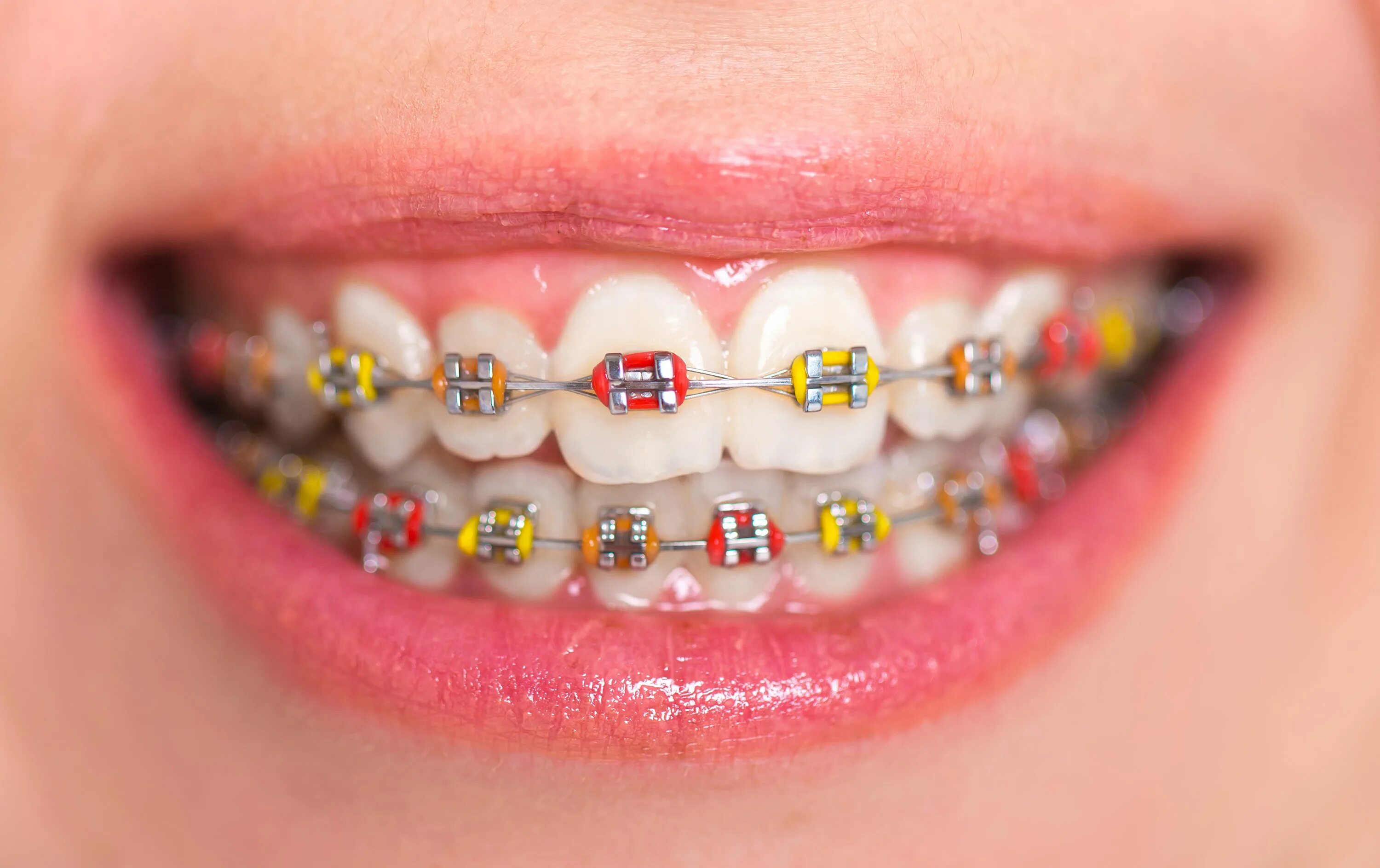 Brackets photo