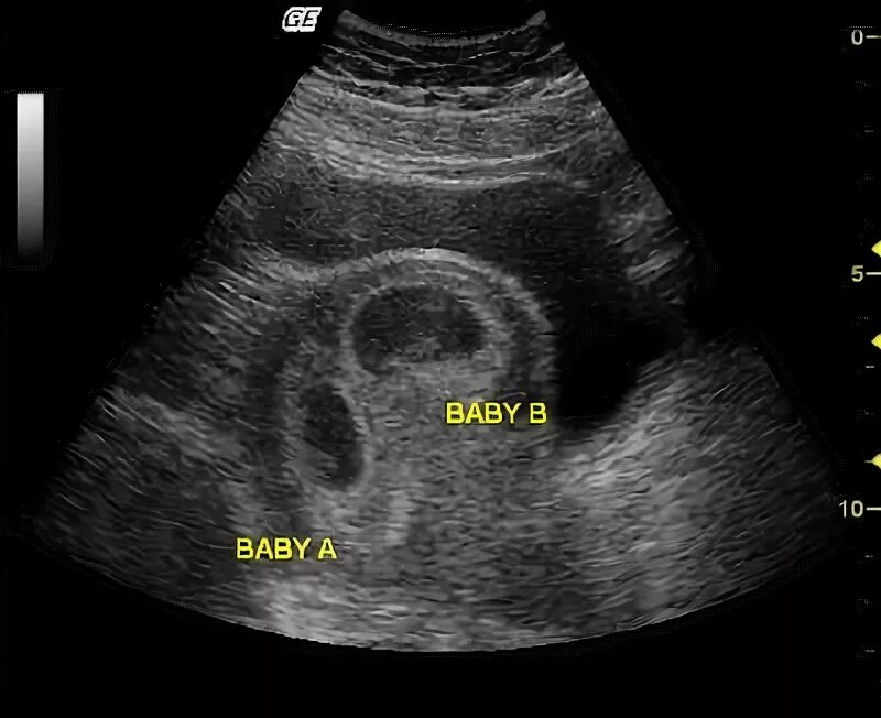 УЗИ 8 недель беременности двойня. УЗИ двухплодной беременности. УЗИ двойняшек на 8 неделе беременности. УЗИ 8 недель многоплодная беременность.