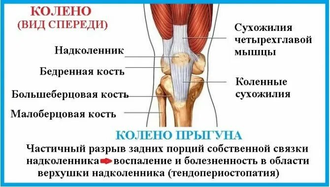 Тендинопатия сухожилия мышцы. Подколенная связка коленного сустава. Тендинит связки надколенника. Если болят связки колена. Разрыв мениска и крестообразной связки коленного сустава.