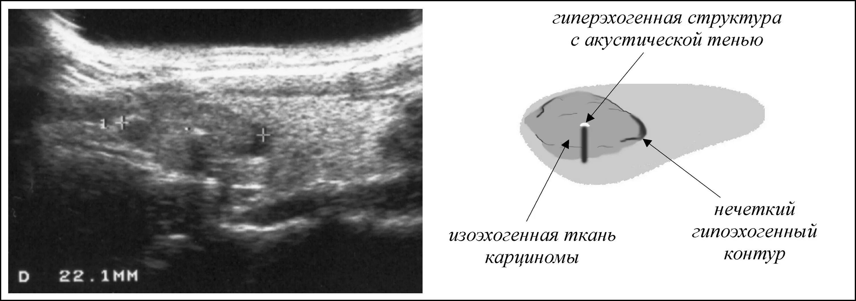 Полость матки неоднородная. Гиперэхогенное образование на УЗИ. Изоэхогенное образование щитовидной. Гиперэхогенная структура на УЗИ. Изоэхогенное образование щитовидной железы что это такое.