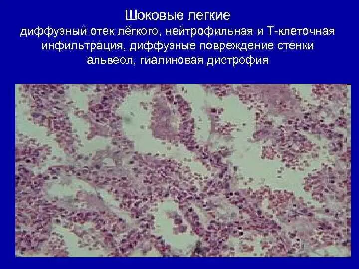 Диффузные повреждения миокарда