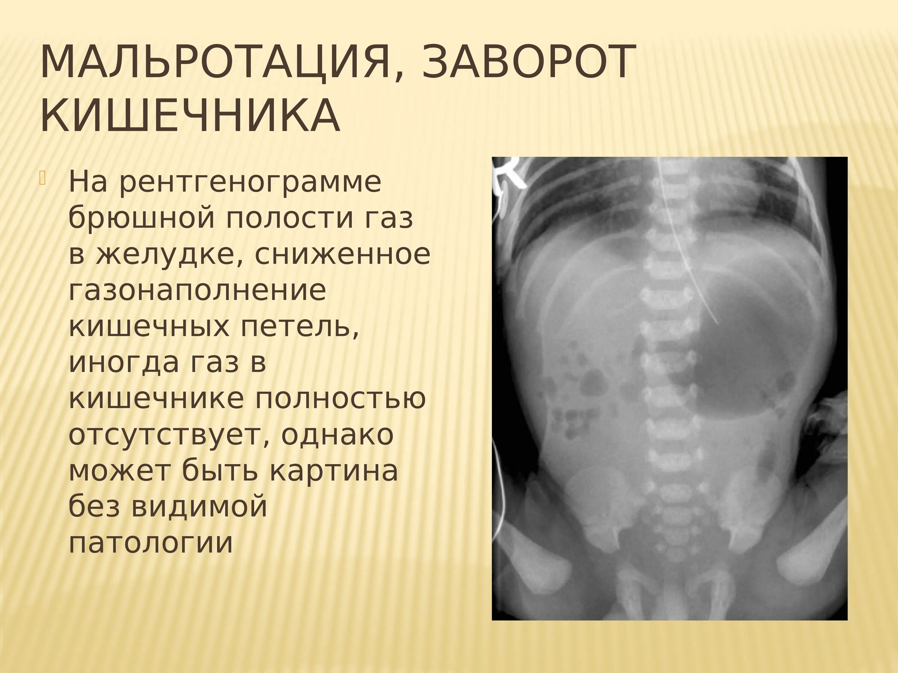 Без видимых патологий. Мальротация на рентгенограмме. Отсутствие газонаполнения кишечника на рентгенограмме. Заворот на рентгенограмме. Мальротация кишечника.