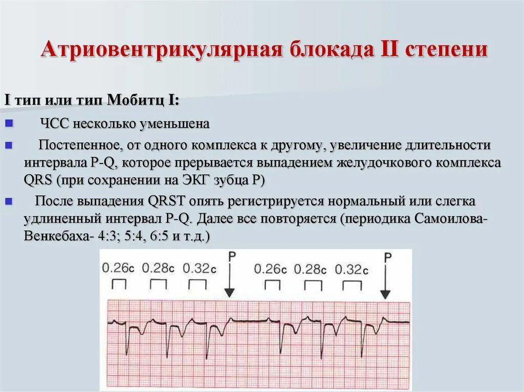 Атриовентрикулярная блокада 2. Атриовентрикулярная блокада 2 степени типа Мобитц 1 характеризуется. Атриовентрикулярные блокады 2 степени Тип II (Мобитц 2). Атриовентрикулярная блокада 1 степени характеризуется. Атриовентрикулярной блокады II степени типа Мобитц i.