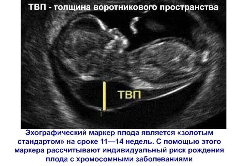 Ксс у плода. 12 Недель беременности УЗИ ТВП. ТВП 12 недель синдром Дауна. ТВП 7.5. Скрининг беременности толщина воротникового пространства.