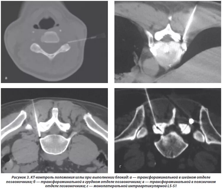 Последствия блокады позвоночника. Блокада грыжи поясничного отдела позвоночника. Блокада при грыже поясничного отдела позвоночника. Блокада на грыжу спинномозгового. Блокада при грыже шейного позвонка.